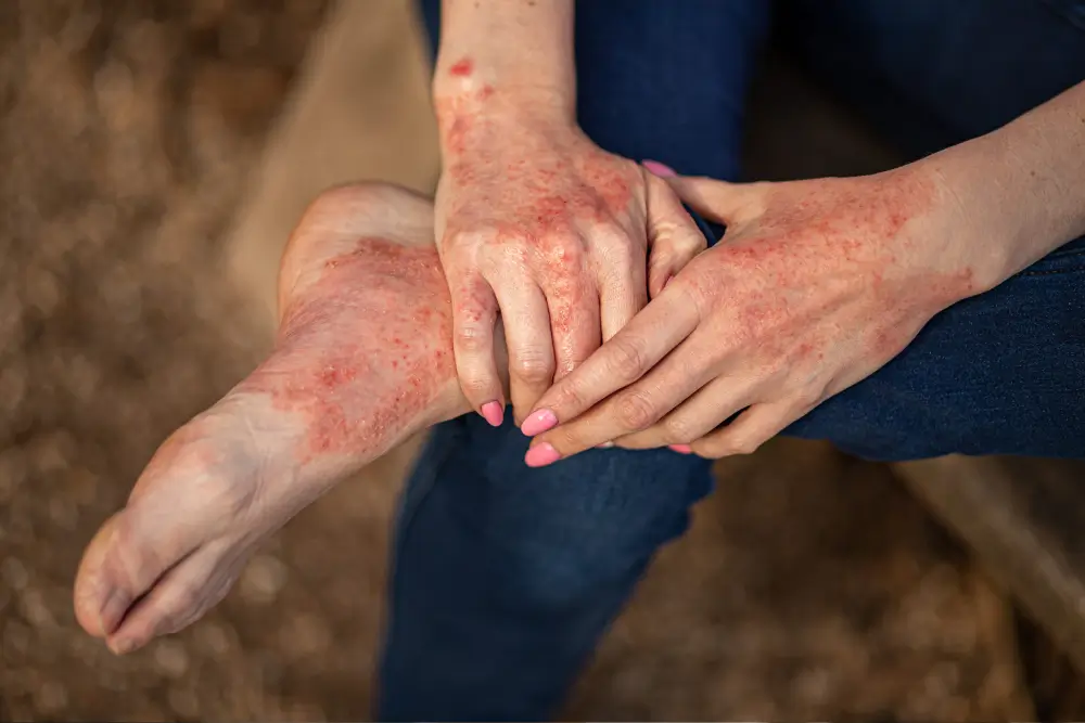 Anaphylactic Reactions