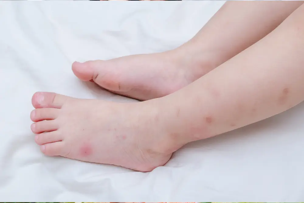 Chronic Urticaria