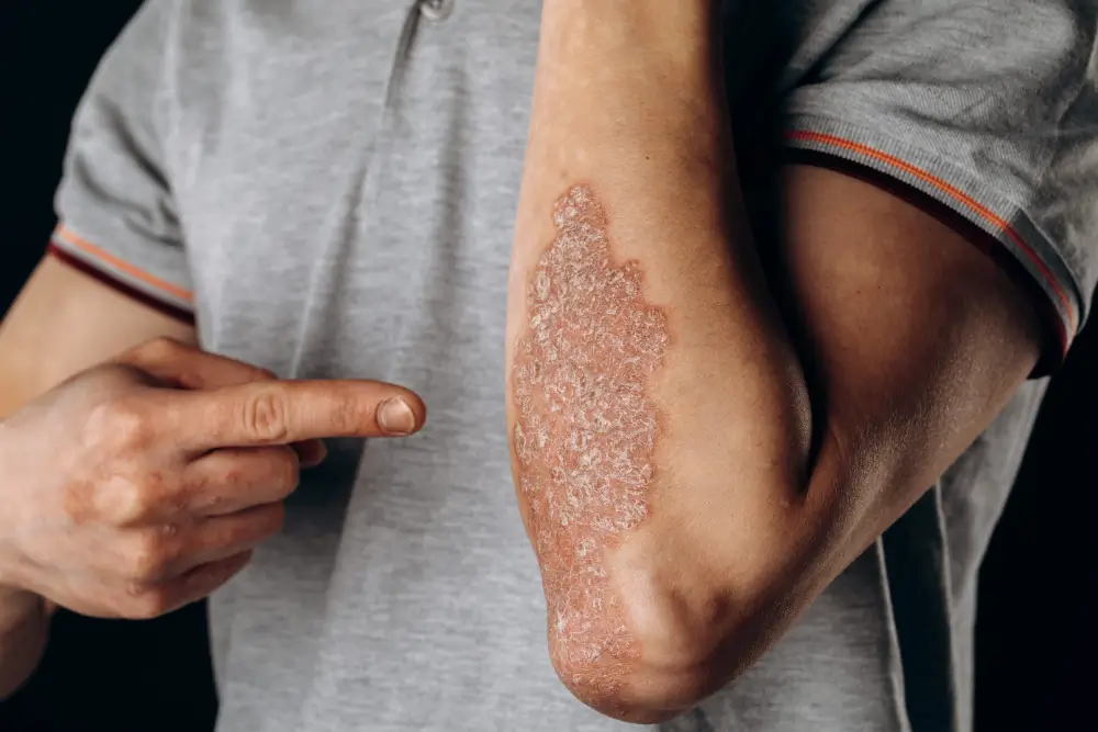 Eczema