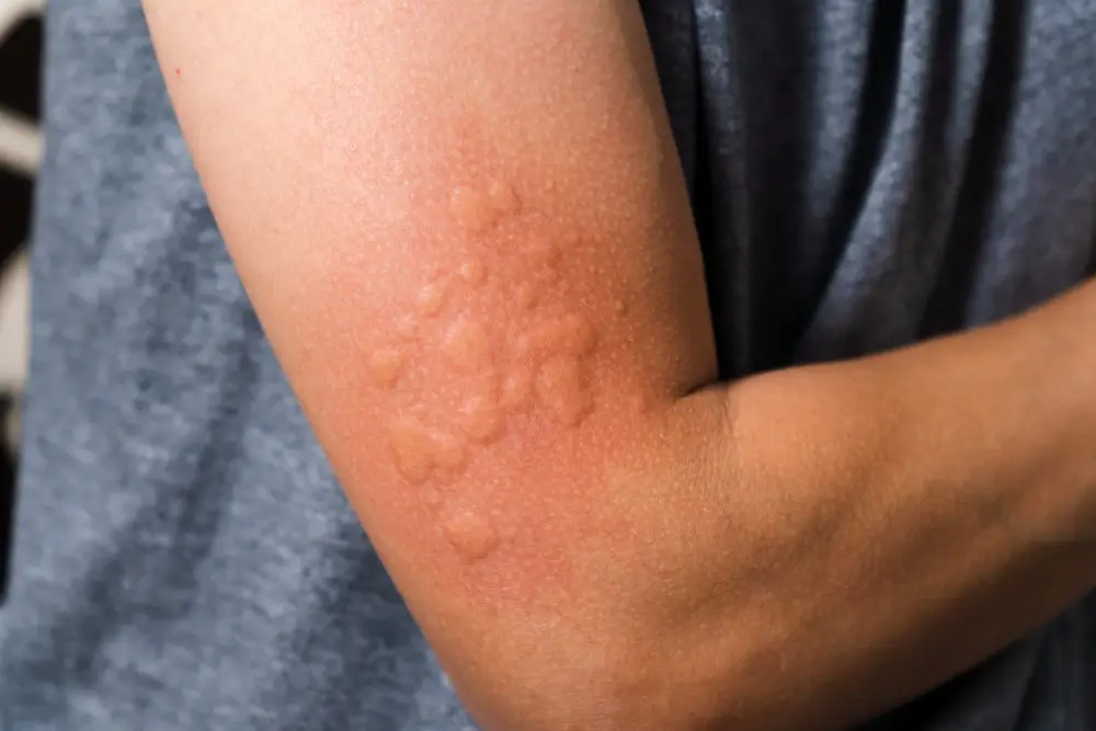 Hives