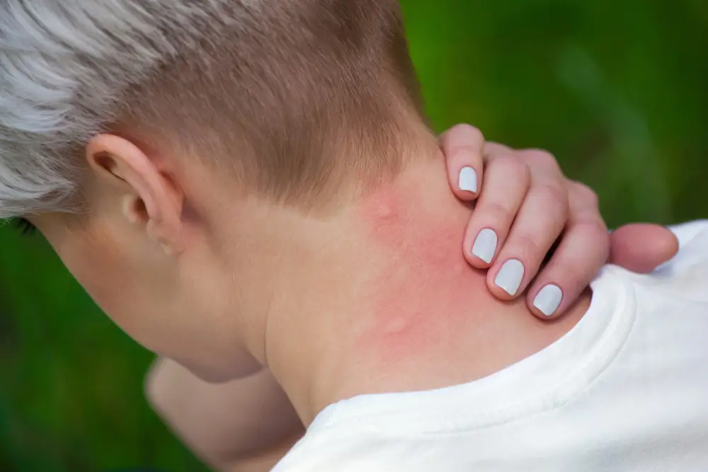 Insect Sting Allergies